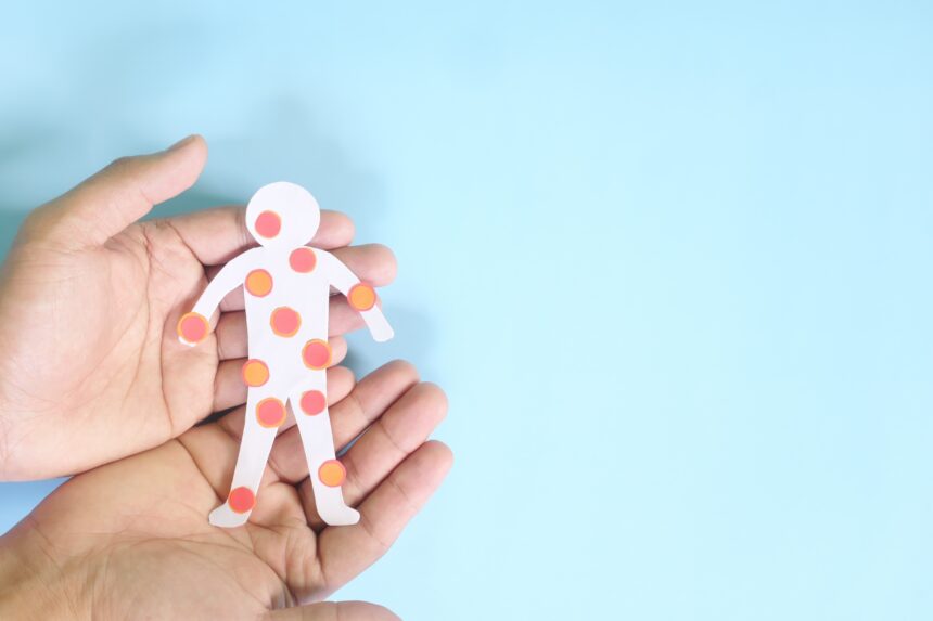 Measles can weaken the body’s defenses, warns Health