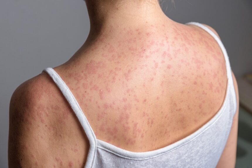 Measles leaves 20 dead and 16,650 cases in Guatemala