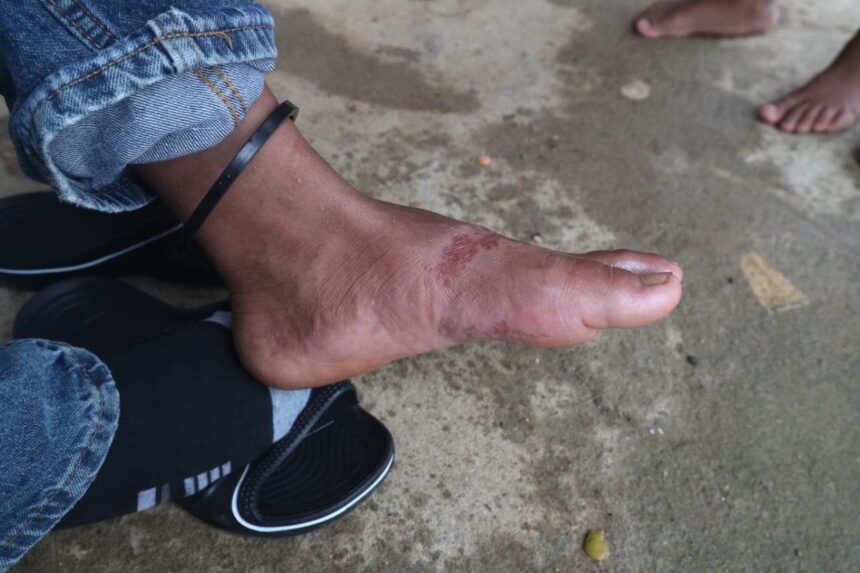 Skin infections affect refugee children in Fray Bartolomé de las Casas after the floods